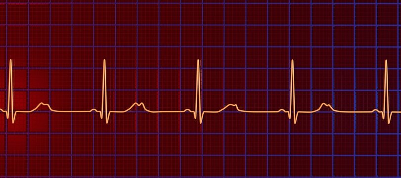 Long QT syndrome, type 2. 3D illustration of an electrocardiogram (ECG) showing prolonged QT interval with notched and of lower amplitude T-waves.