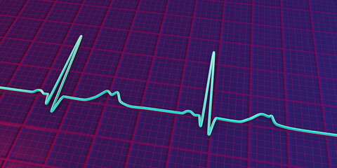 Long QT syndrome ECG, 2nd type, 3D illustration
