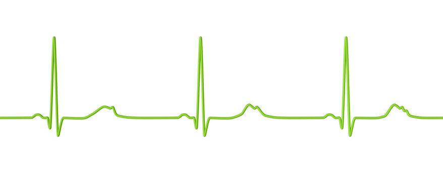 Long QT syndrome ECG, 2nd type, 3D illustration
