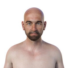 A man with miosis, illustration