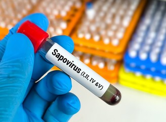 Fototapeta premium Lab Technologist hold blood sample for Sapovirus (i,ii,iv, v) test. Laboratory medical testing concept