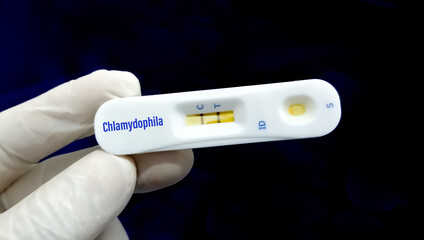 Microbiologist holding rapid test cassette for Chlamydophila test.