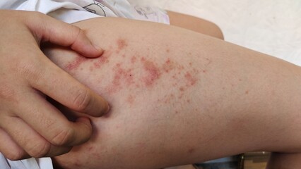 close up of a patient scratching the rash hives allergy and inflammation skin, reaction and urticaria, scar and acne on the leg of the woman, health care and medical concept.