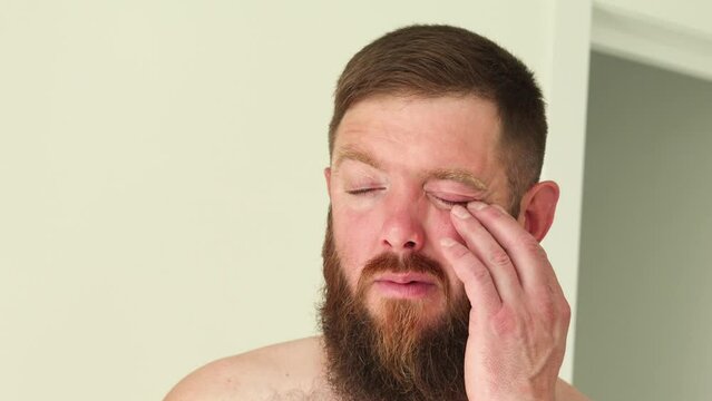 Male patient's infected eye. The blue-eyed bearded man staring at the camera has an external stye bacterial infection. Hordeolum on upper eyelid. Viral Infection. Staphylococcus. Ophthalmology