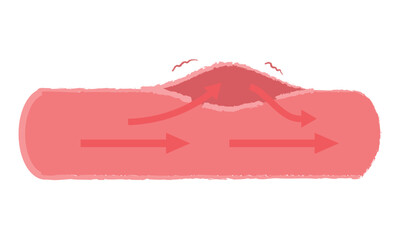 大動脈乖離の症状 血管断面図イラスト