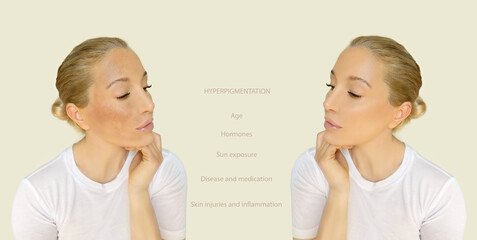 Dark spots, freckles,hyperpigmentation(melasma or chloasma),concept - skin lightening, skin whitening, fruit acids,AHA, Skin Brightening