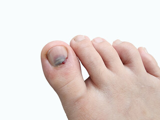 Subungual Hematoma is bleeding and bruising under the fingernails or toenails. It is usually caused...