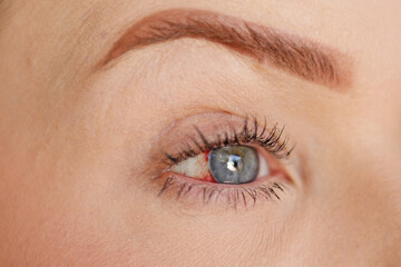 Blue eye on the right side of a woman, without identifying the person, with ocular hemorrhage,...