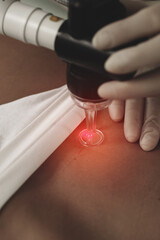 Laser treatment and scar removal after C-section surgery