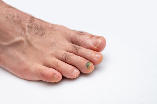 Cropped shot view of black, green nail called runner's toe. Man's toenail damage from toe rubbing against the front of the shoe. Running injury. 