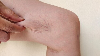 close up of a person holding a varicose veins and spider, wrinkly and loose on the leg, problem circulation of blood, health care and beauty concept.