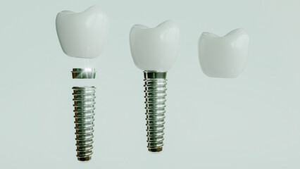Dental Implants 3D Rendering