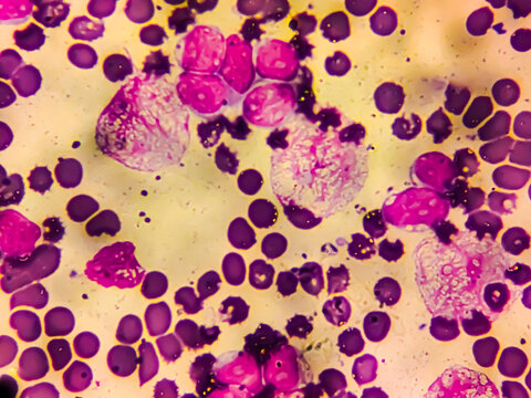 Acute lymphoblastic leukemia (ALL), Mature B-cell analysed by light microscope. Which is known as Burkitt leukemia. Close up micrograph.
