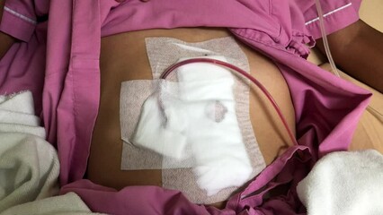 Abdomen of middle age man has wound,has Metal staple on wound,after surgery due to leaky intestines and stomach,selective focus.
