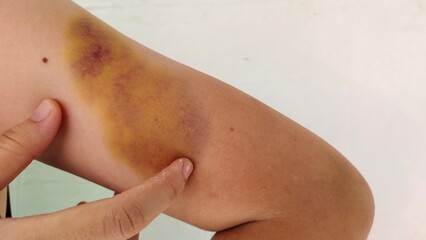 person with a pain, Swollen and bruised arm of teenage girl, health care and medical concept.