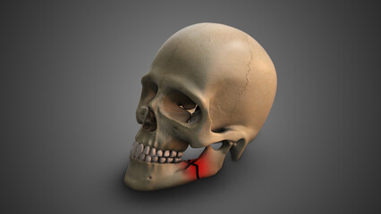 A skull with Broken Jaw