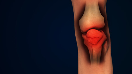Naklejka premium Leg bone Fracture or inflammation of human knee cap