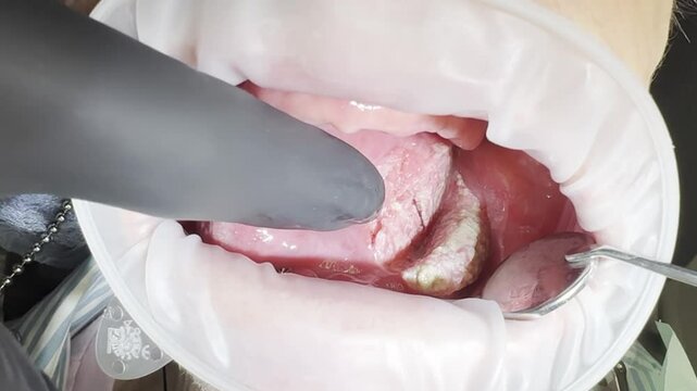 Suspicion of leukoplakia in the human oral cavity during examination by a dentist. High quality FullHD footage