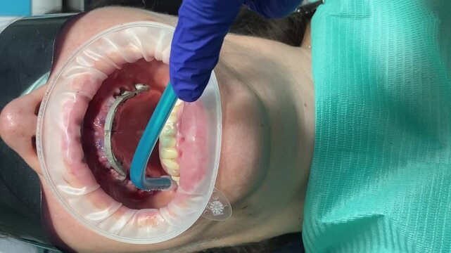 dentistry. preparation for immediate loading of the jaw. intraoral welding of cobalt-chromium alloy beams in the patient's oral cavity. Vertical video