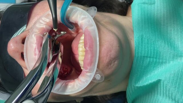 dentistry. preparation for immediate loading of the jaw. intraoral welding of cobalt-chromium alloy beams in the patient's oral cavity. Vertical video