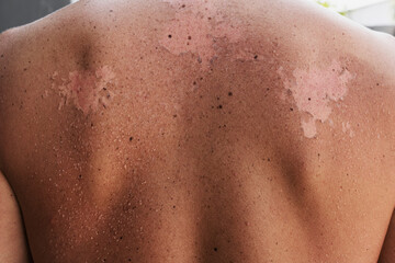 Fototapeta premium Close-up of a male back with peeling skin due to sunburn