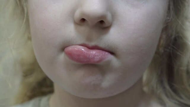 a swollen lip in a child, bee sting, little girl with swollen lip, lip after after anesthesia