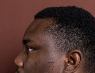 Brown skin with dark spots, hyperpigmentation on brown skin, african american man with skin...