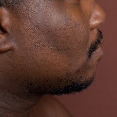 Brown skin with dark spots, hyperpigmentation on brown skin, african american man with skin...