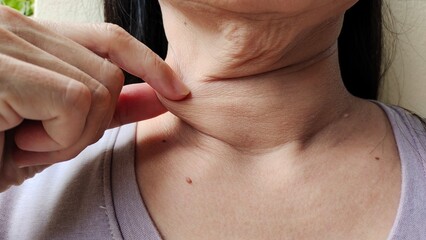 Portrait the fingers holding the flabbiness adipose sagging skin under the chin, neck wattle and cellulite, wrinkle and Flabby skin, the mole on the body, health care and beauty concept.