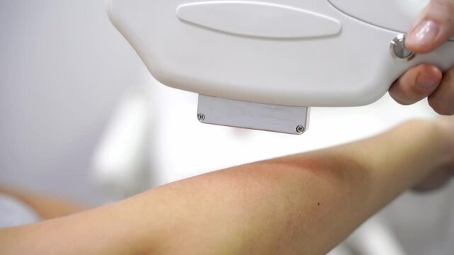 Armpit procedure. A professional dermatologist uses modern technology for laser hair removal. The lady undergoes a rejuvenating treatment, enhancing skin health in a well-equipped beauty clinic. Hand