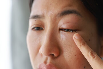 Woman's eyes become inflamed after rubbing her eyes violently. Insects entering eye cause irritation and wounds to cornea, causing eye to become swollen and red. Ophthalmologist treats eye infections.