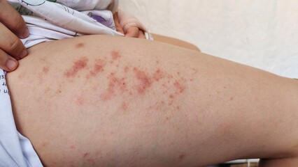 Portrait the rash, hives, allergy and inflammation skin, reaction and urticaria, scar and dark spots on the leg of the teenage girl, health care and medical concept.