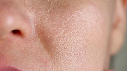 skin texture on large pores. oily troubled facial skin close-up. dermatology cosmetology concept