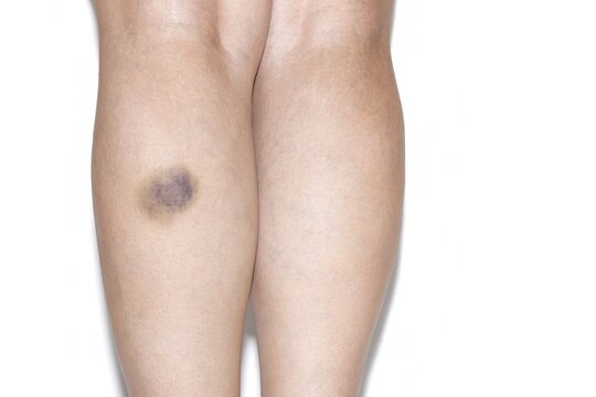 A tremendous superficial bruise on a girl leg, isolated on white background