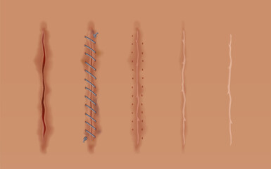 Set of healing wounds, skin scars, stitched gash and cuts. Realistic surgical sutures, stitched wounds at different healing stages isolated on human skin background