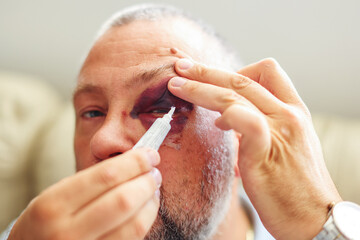 white man with a purple black eye and head injury - eye closed. apply ointment for healing