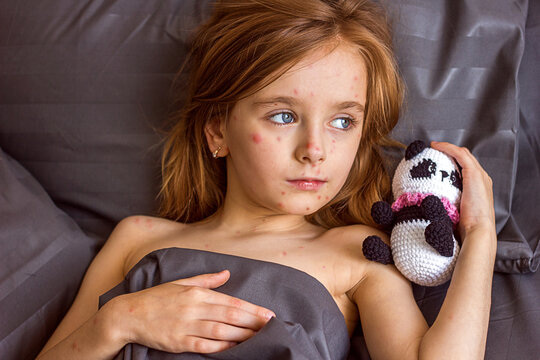 Little sad girl with a rash on her face and body lies in bed with a toy, chickenpox or measles virus in children