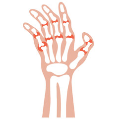 Illustration rheumatoid arthritis osteoarthritis of joints of the fingers vector design