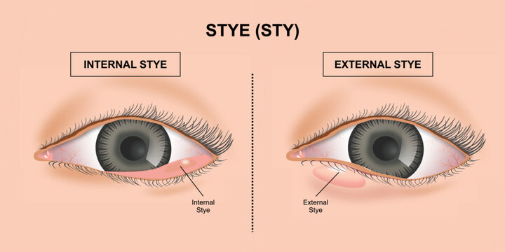 Types of Stye (Sty) illustration