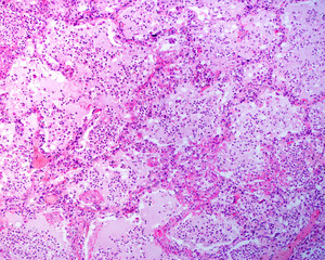 Human lung. Acute pneumonia