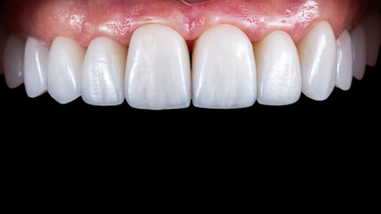 ceramic crowns and veneers bl3 color