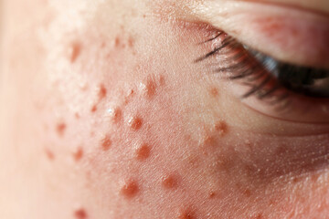 Fototapeta premium close up of skin with pink circular birth marks on it, white background