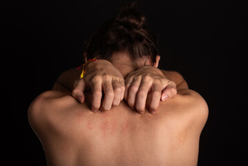 Young man, shirtless, scratching his back with his hands. Skin disease. Irritation, allergy.