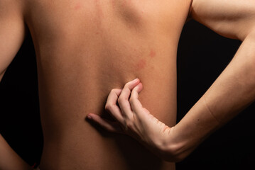 Young man, shirtless, scratching his back with his hands. Skin disease. Irritation, allergy.