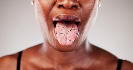 African American woman with oral candidiasis experiencing dry tongue pain