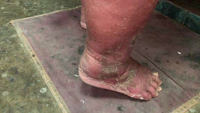 Leg and foot of Elderly has Skin infections, swollen foot, Ankle injury. First aid concept.