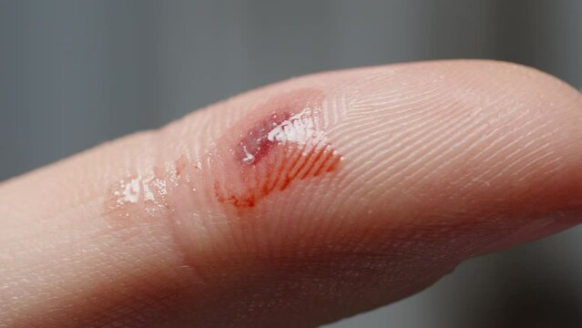 Man moistens a wound on his finger with hydrogen peroxide solution, killing harmful microbes and disinfecting it.