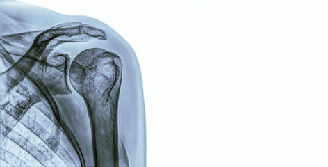 patient who have shoulder pain. part of human female shoulder, high quality x-ray on white...