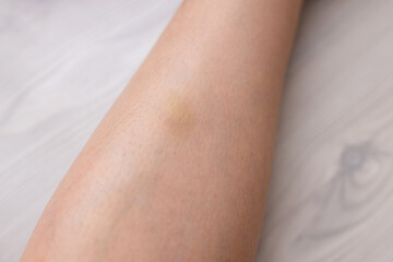 Bruise on the leg of a woman. A bruised leg. Close-up.