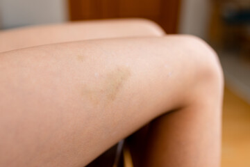 Bruised skin on a human leg resting on a beige couch with visible marks from an injury taken during...